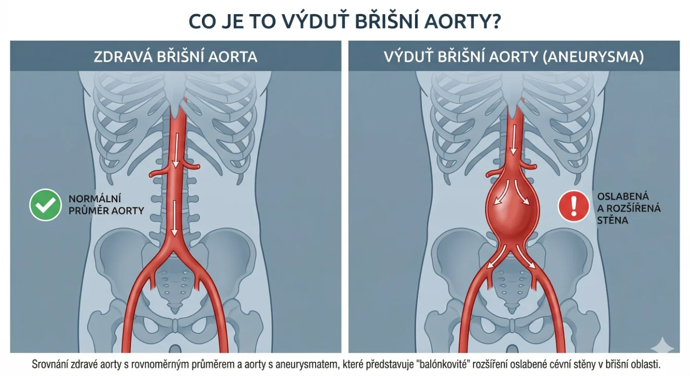 Co je to výduť břišní aorty a kde se nachází – porovnání zdravé a nemocné tepny.